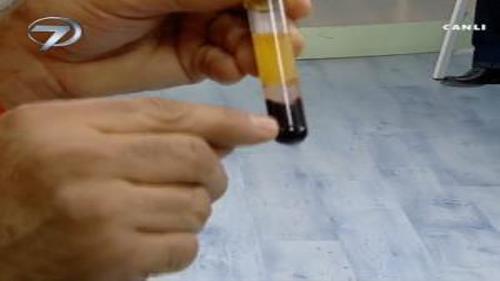 İNSAN KANINDAN YAPILAN DOĞAL KREM